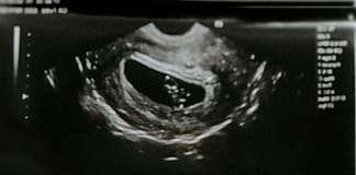 Defectos congénitos más recurrentes por el consumo de alcohol en el embarazo